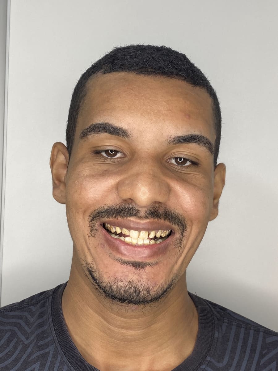 Paciente antes do tratamento com facetas