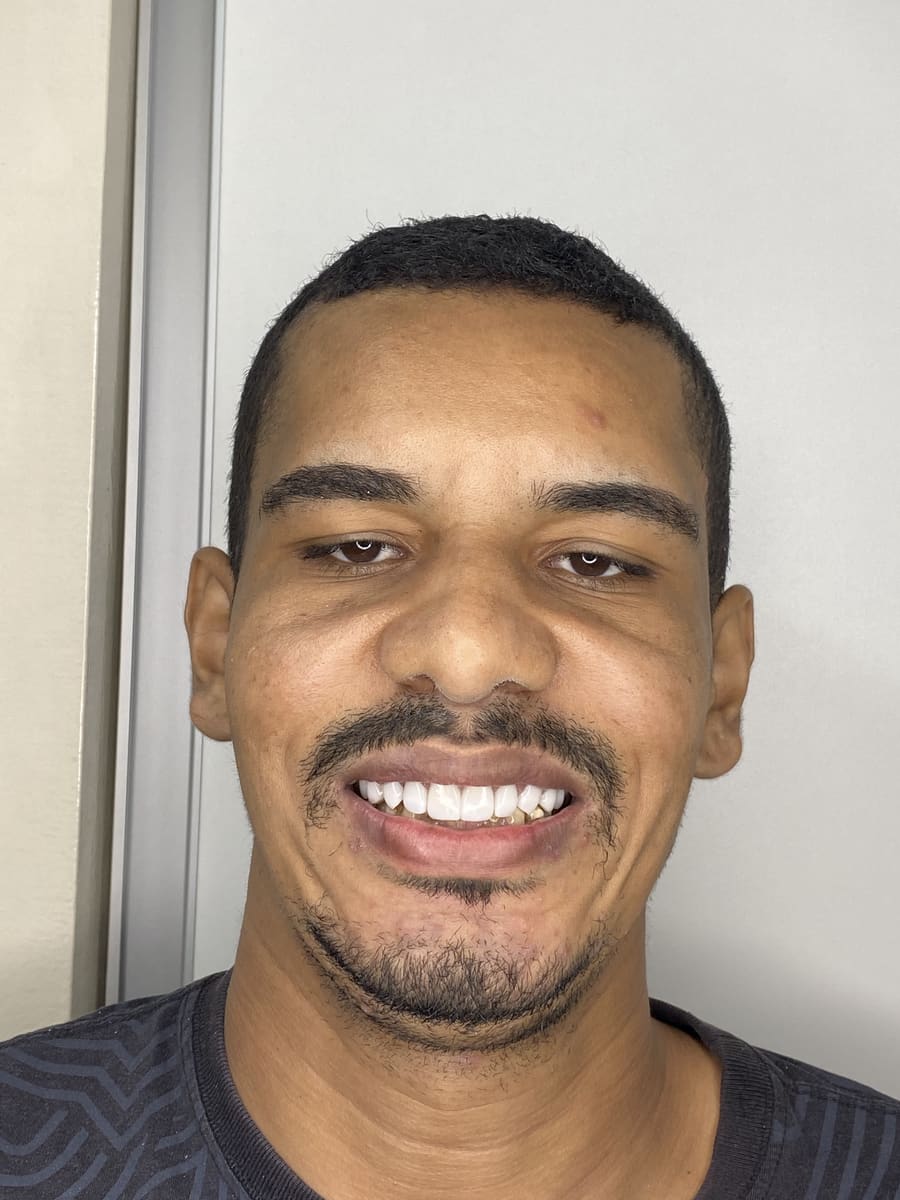 O mesmo paciente depois do tratamento com facetas