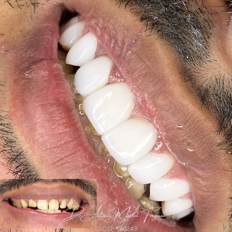 Sorriso com facetas em close; no canto, o mesmo sorriso antes do tratamento