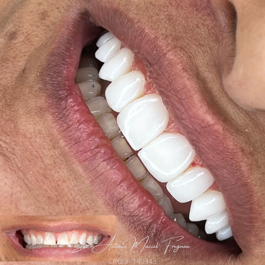 Sorriso com facetas em close; no canto, o mesmo sorriso antes do tratamento