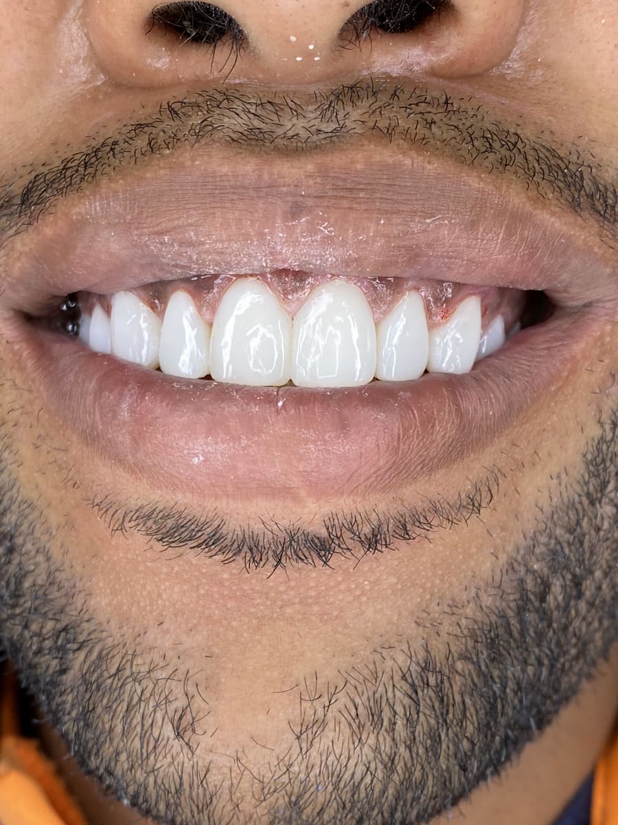 Sorriso com facetas em close