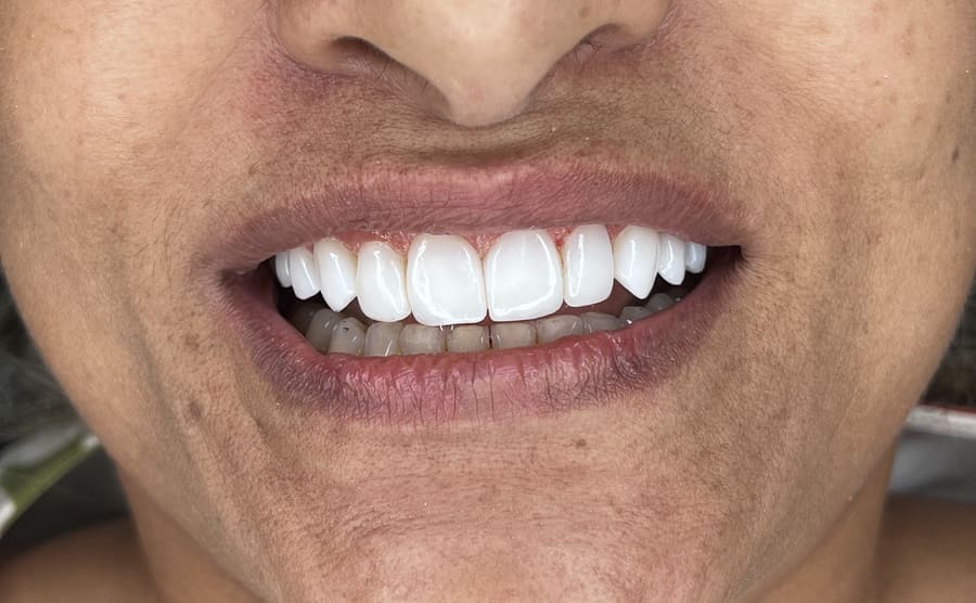 Sorriso com facetas em close