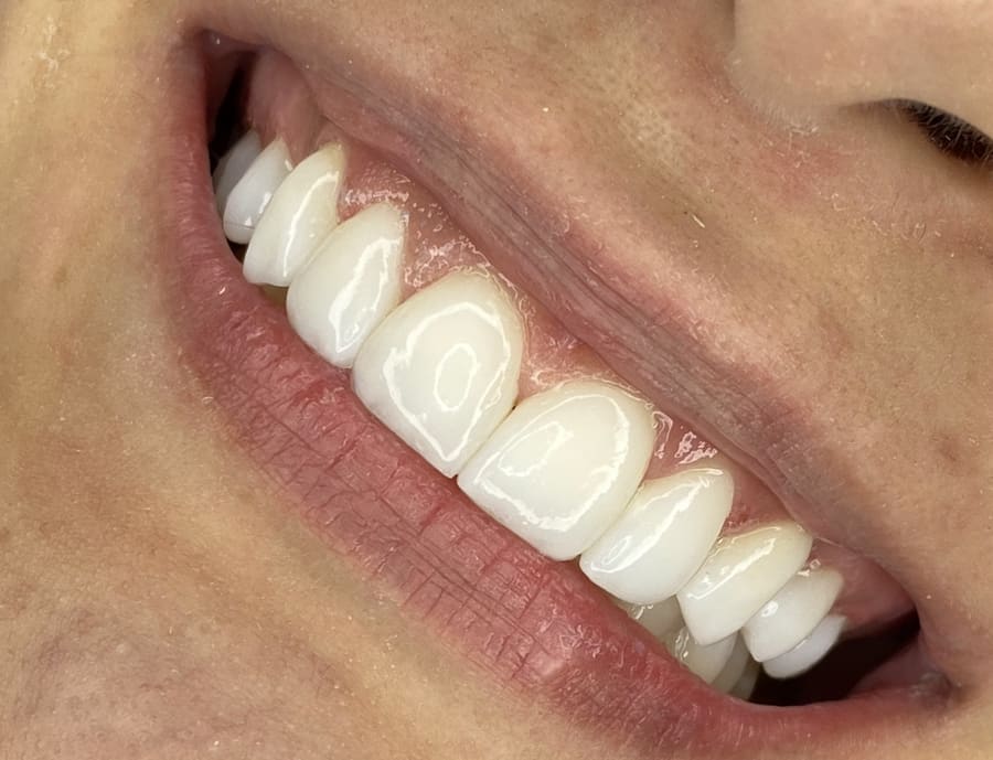 Sorriso com facetas em close, visto de lado