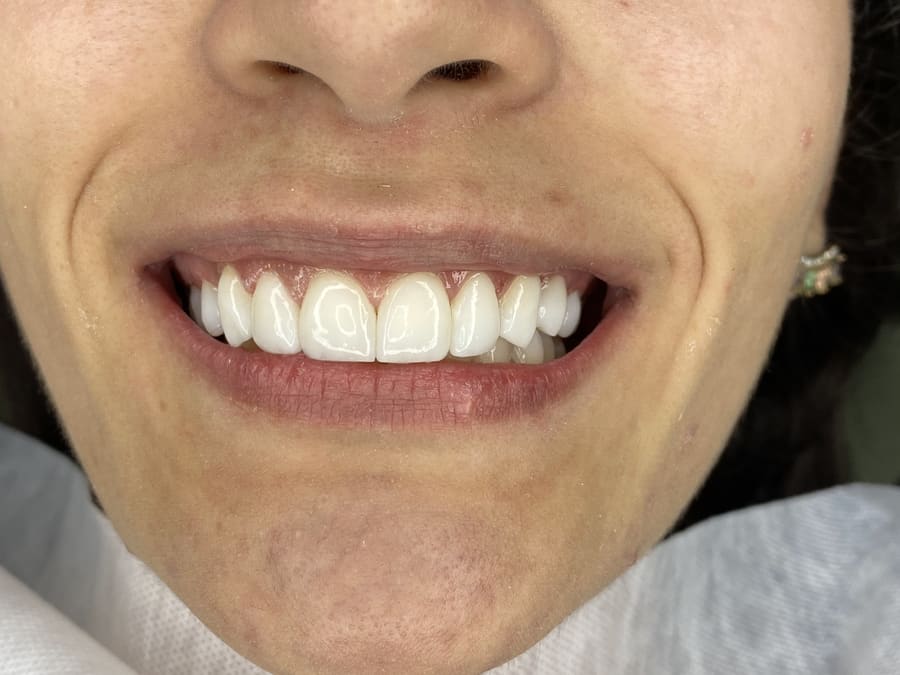 Sorriso com facetas em close
