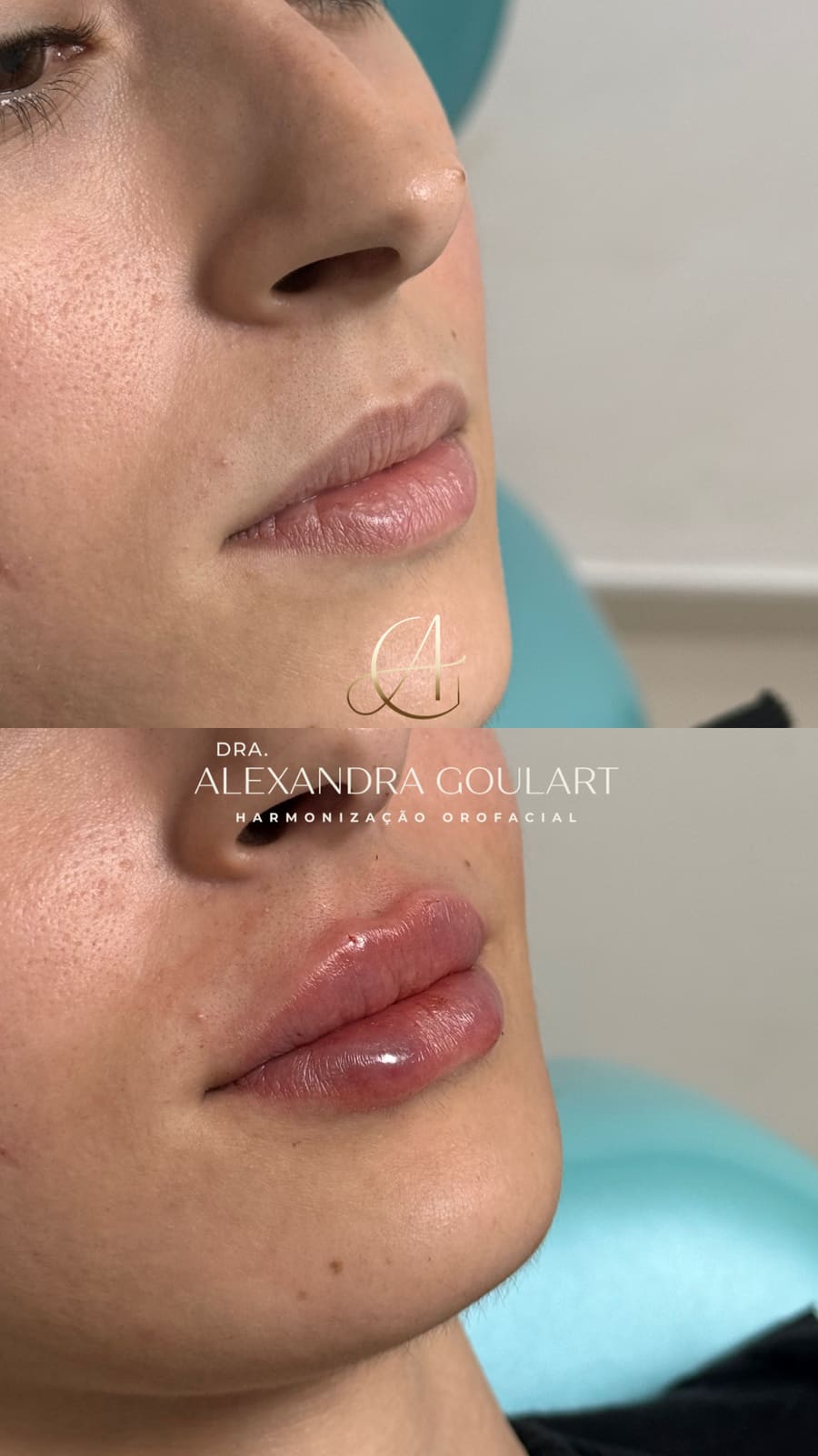 Registro de um caso de harmonização orofacial