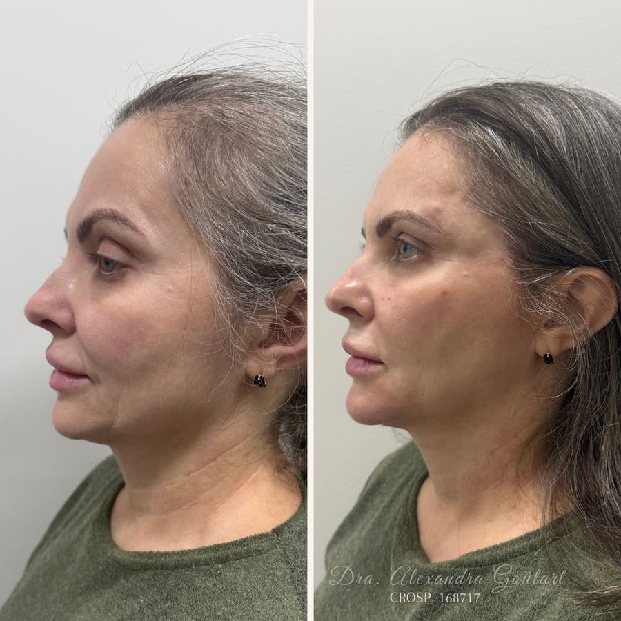 Registro de um caso de harmonização orofacial