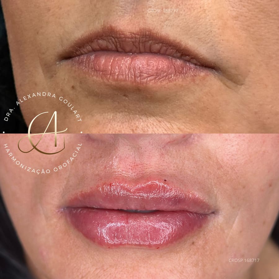 Registro de um caso de harmonização orofacial