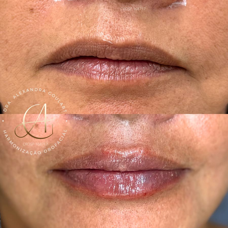 Registro de um caso de harmonização orofacial