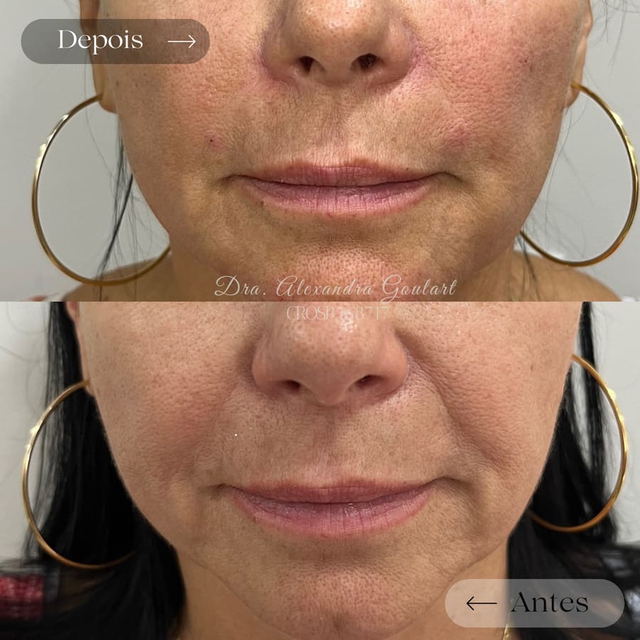 Registro de um caso de harmonização orofacial