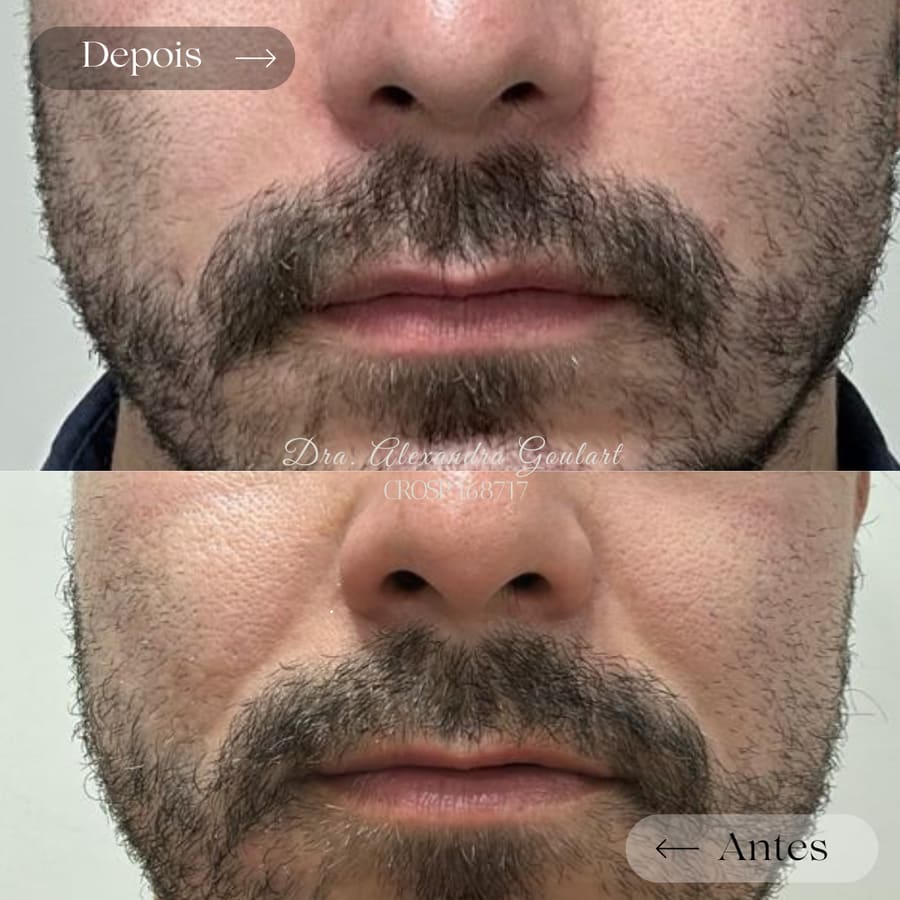 Registro de um caso de harmonização orofacial