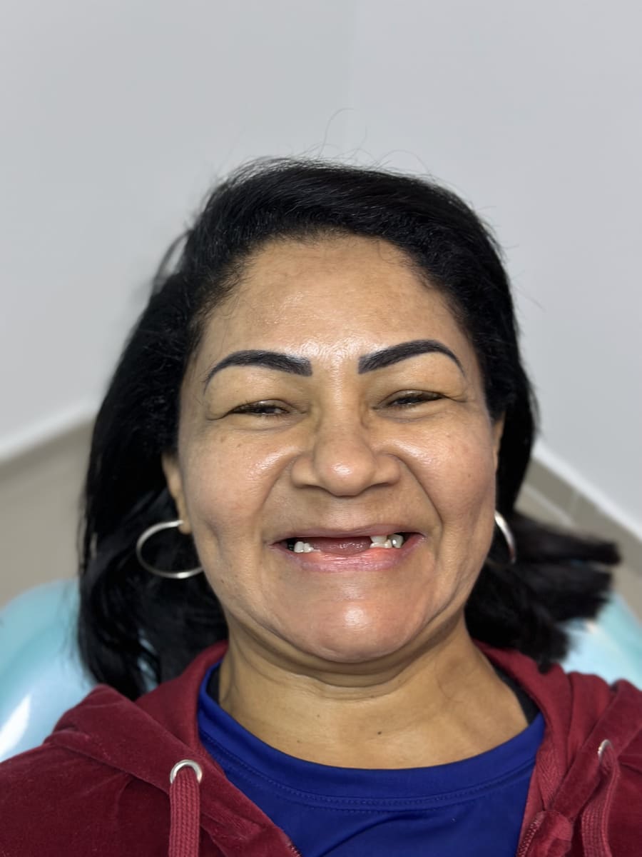 Paciente antes da reabilitação com protocolo dentário