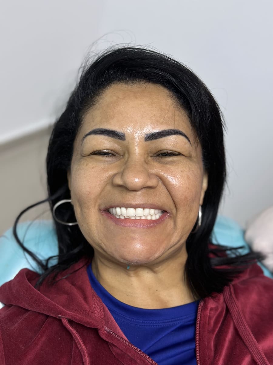 A mesma paciente depois da reabilitação com protocolo dentário